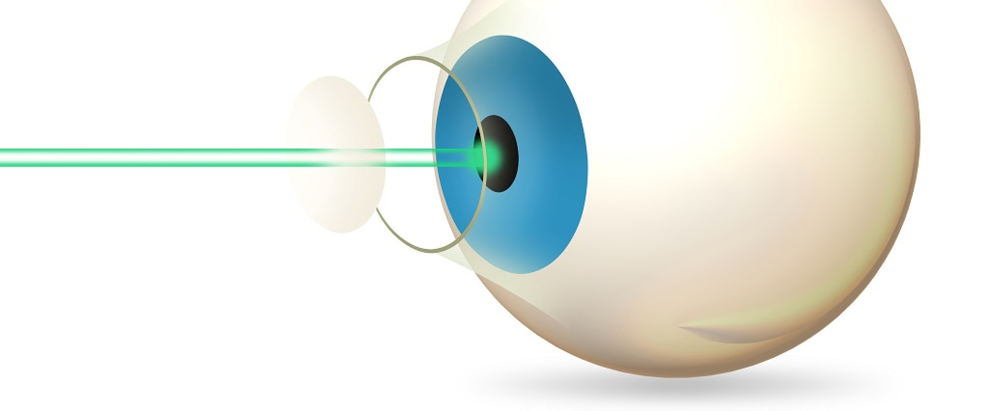 What Causes Undercorrection in LASIK Surgery?