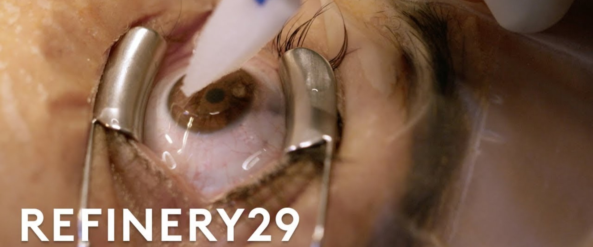 Should i get lasik at 36?
