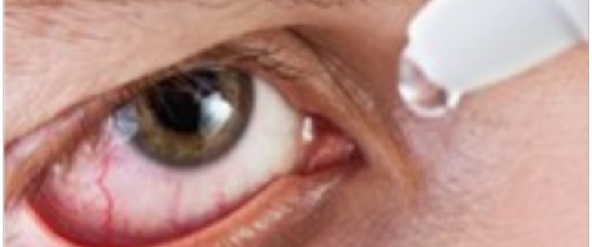 What Are the Risks of Getting LASIK with Dry Eyes?