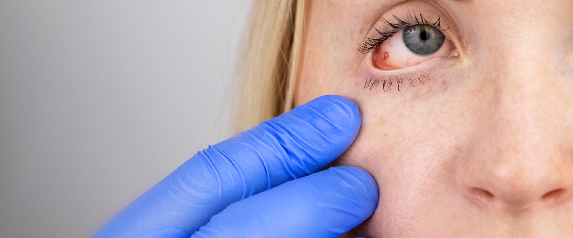 Can you have prk if you have glaucoma?