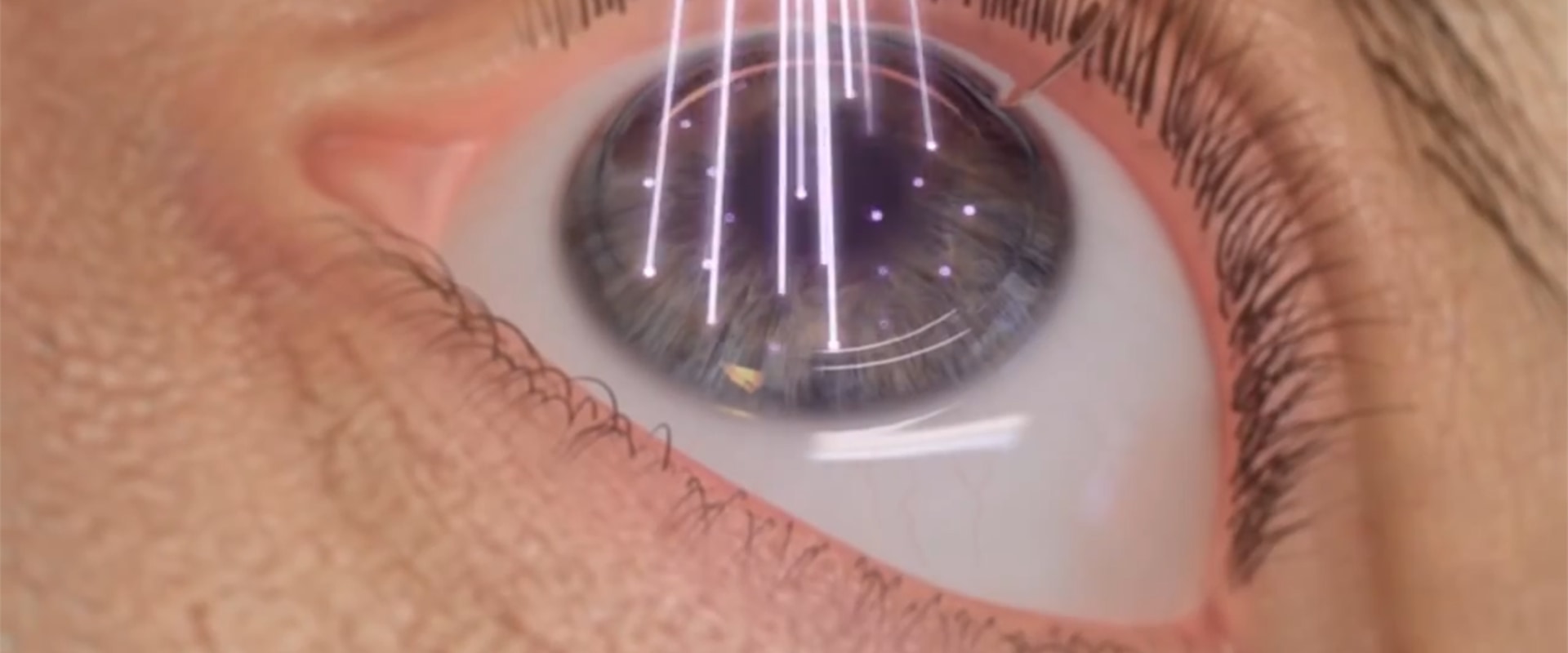 Can you be denied lasik?
