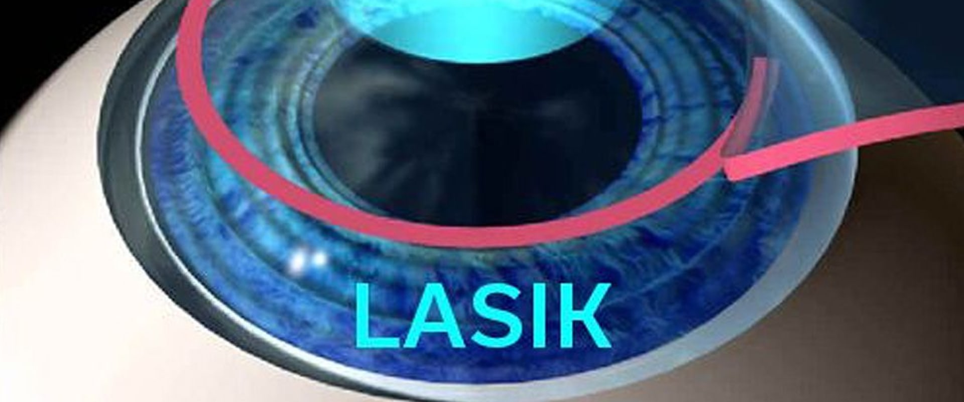 LASIK vs PRK: Which Laser Eye Surgery is Right for You?
