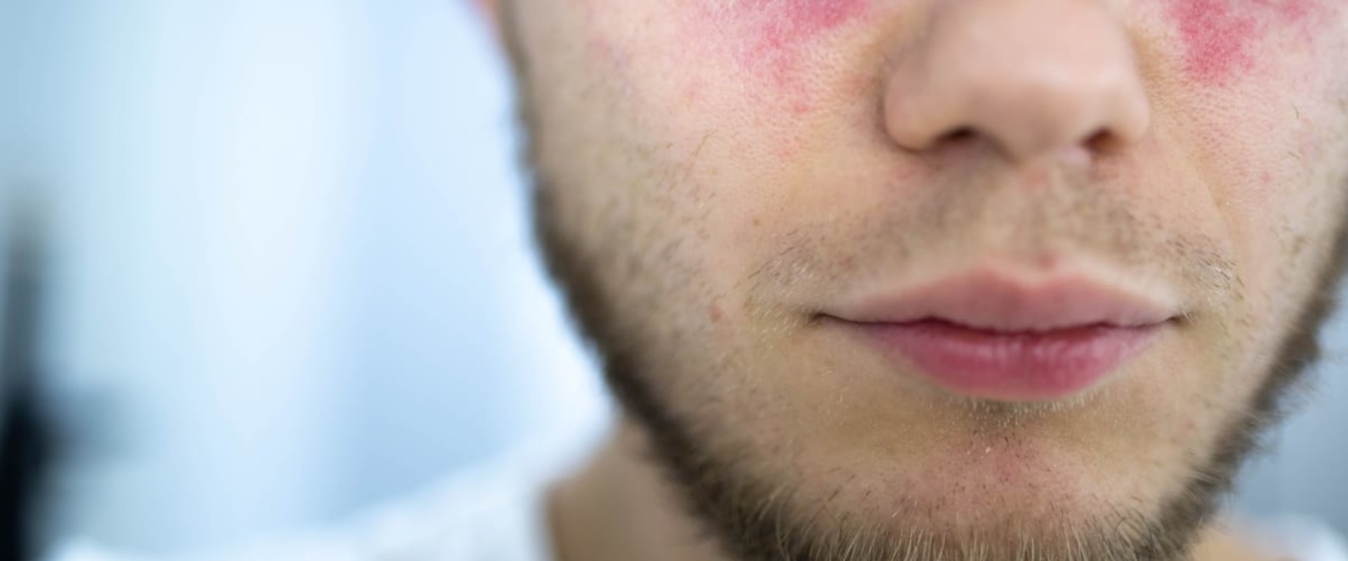 Can People with Lupus Safely Undergo LASIK Surgery?