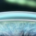 How Common is Undercorrection in LASIK Surgery?