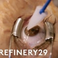 Should i get lasik at 36?