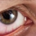 What Are the Risks of Getting LASIK with Dry Eyes?