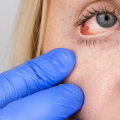 Can you have prk if you have glaucoma?