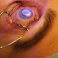 Is LASIK Surgery Right for You?