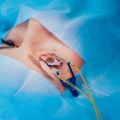 Can I Be Put to Sleep for LASIK Surgery?
