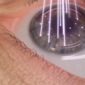 Can you be denied lasik?