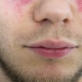 Can People with Lupus Safely Undergo LASIK Surgery?