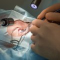 Can I Be Put to Sleep for LASIK Surgery?