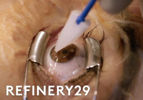 Should i get lasik at 36?