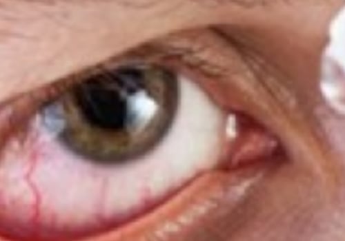 What Are the Risks of Getting LASIK with Dry Eyes?