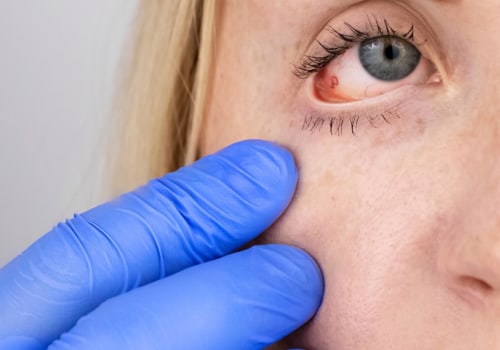 Can Glaucoma Patients Get PRK?