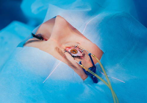 Why don't they put you to sleep for lasik?