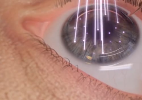 Can you be denied lasik?
