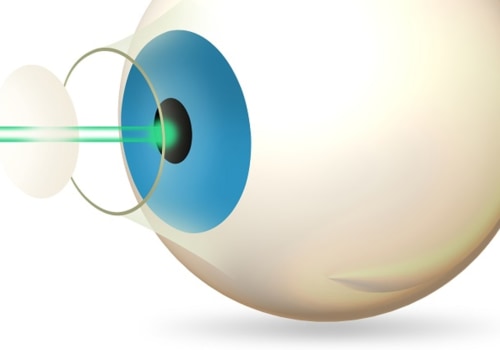 How Long Does Lasik Eye Surgery Last?