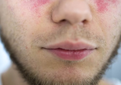 Can People with Lupus Safely Undergo LASIK Surgery?