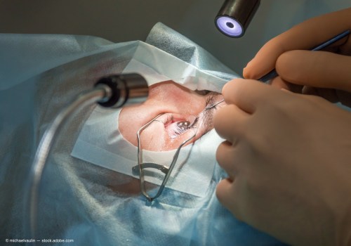 Can I Be Put to Sleep for LASIK Surgery?
